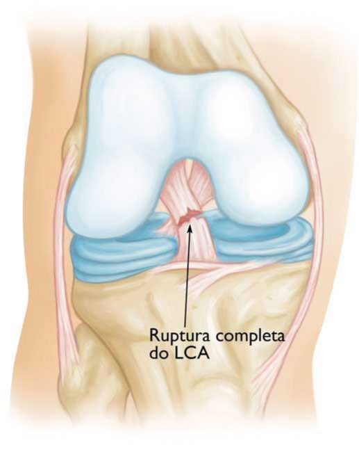 Ligamento Cruzado Anterior Dr Fabio Pacheco